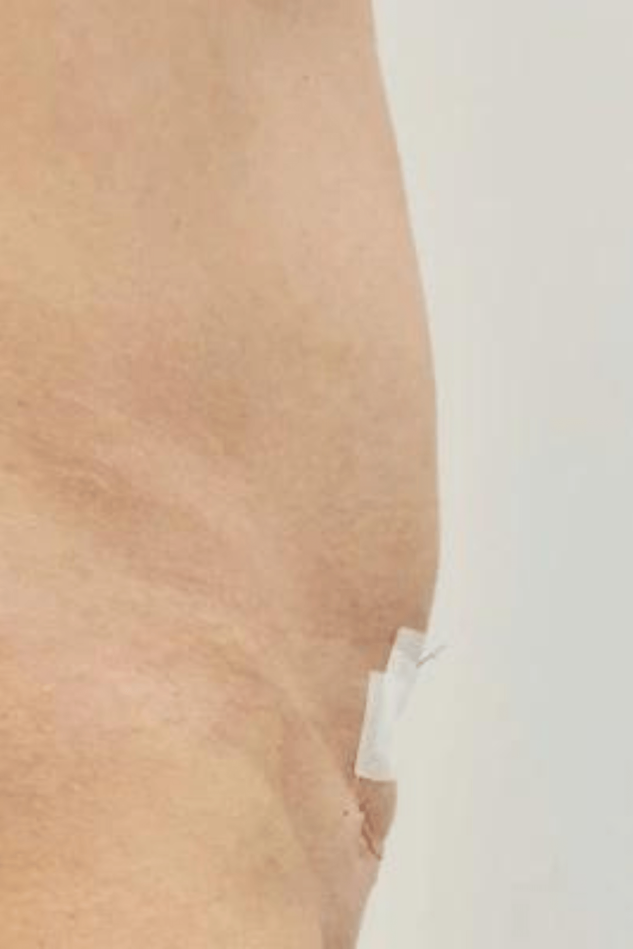 Reparación de cicatrices en Elegansse